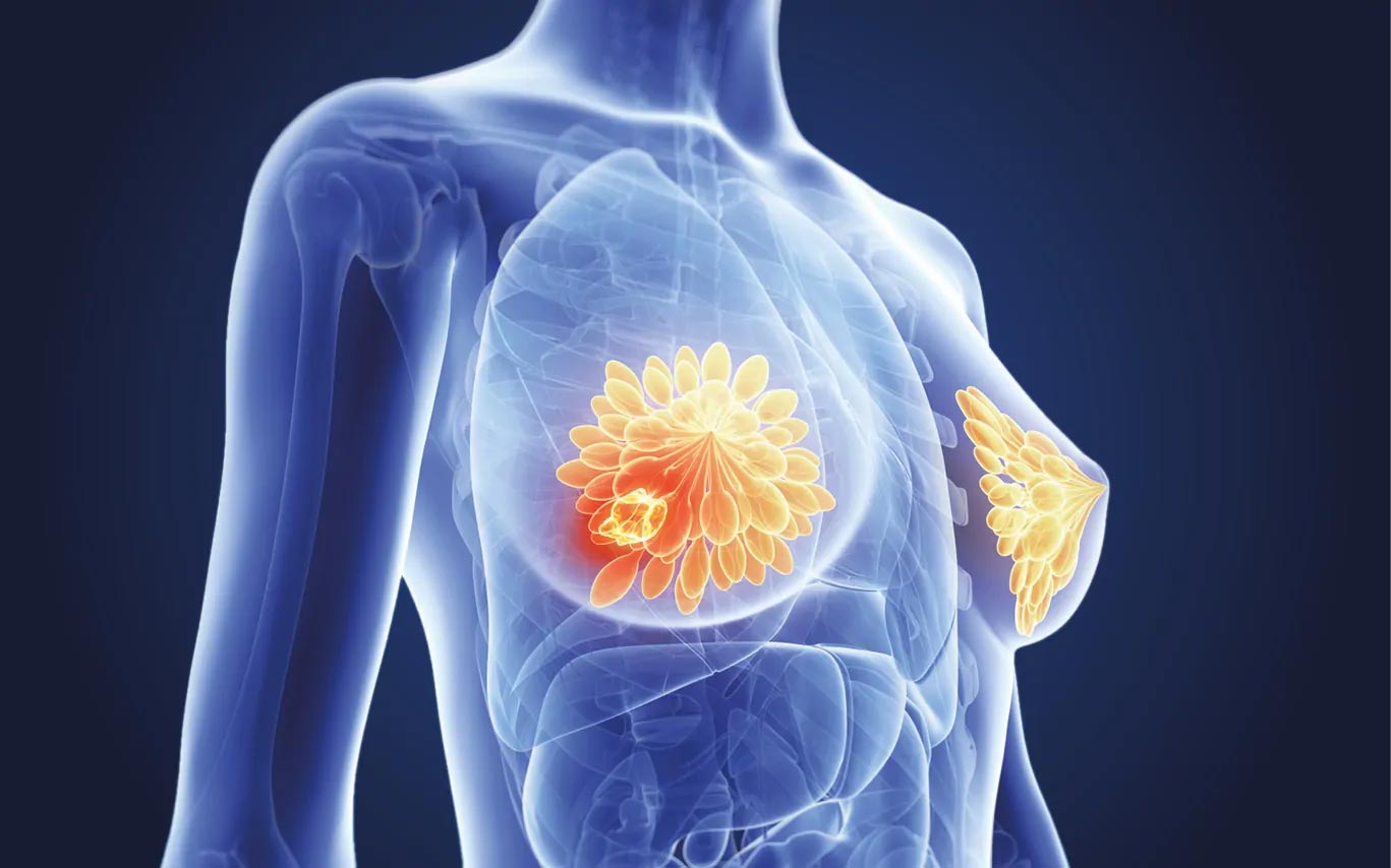 rak_dojke_bela_omela